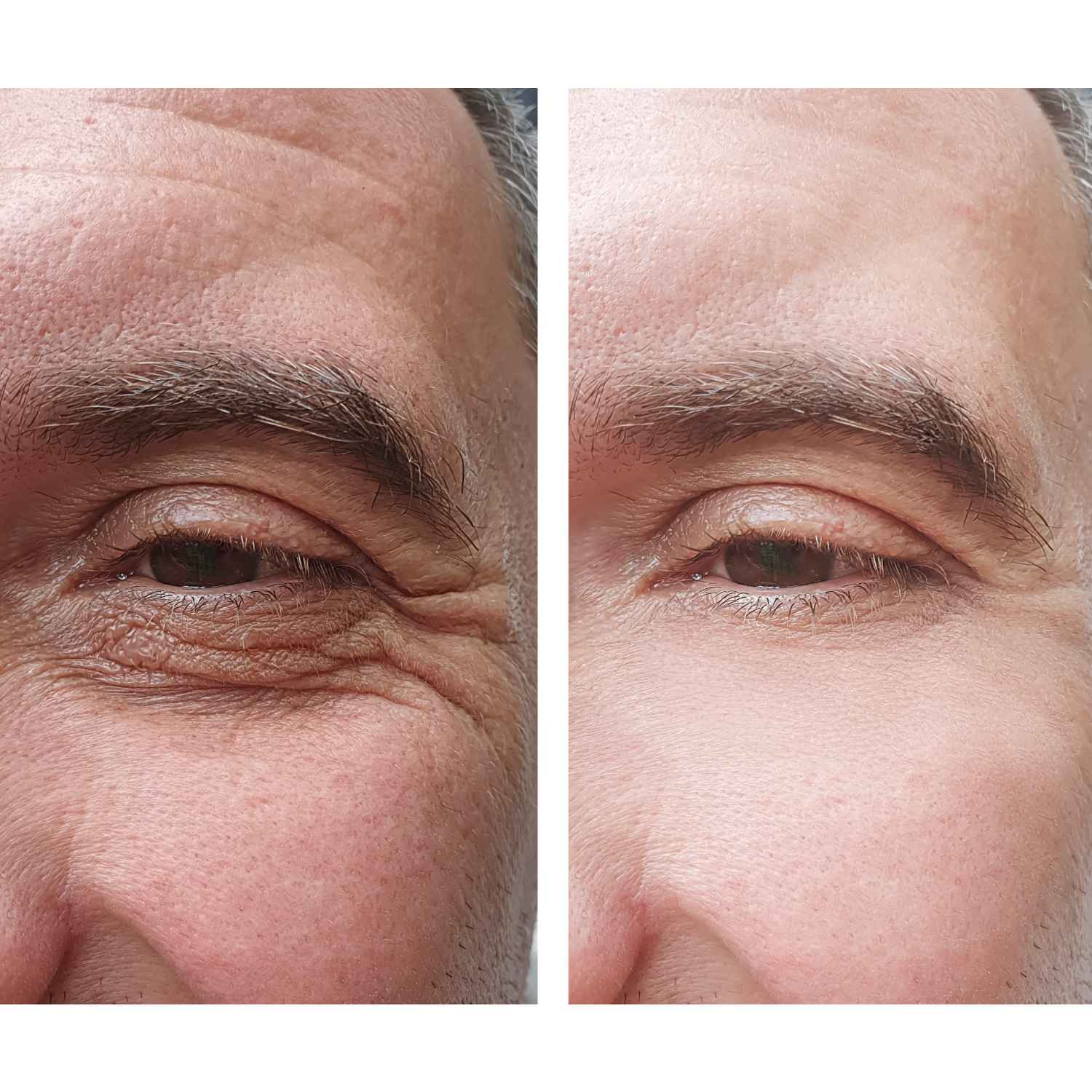 Botox for men after and before Flawless Skin MedSpa Newyork