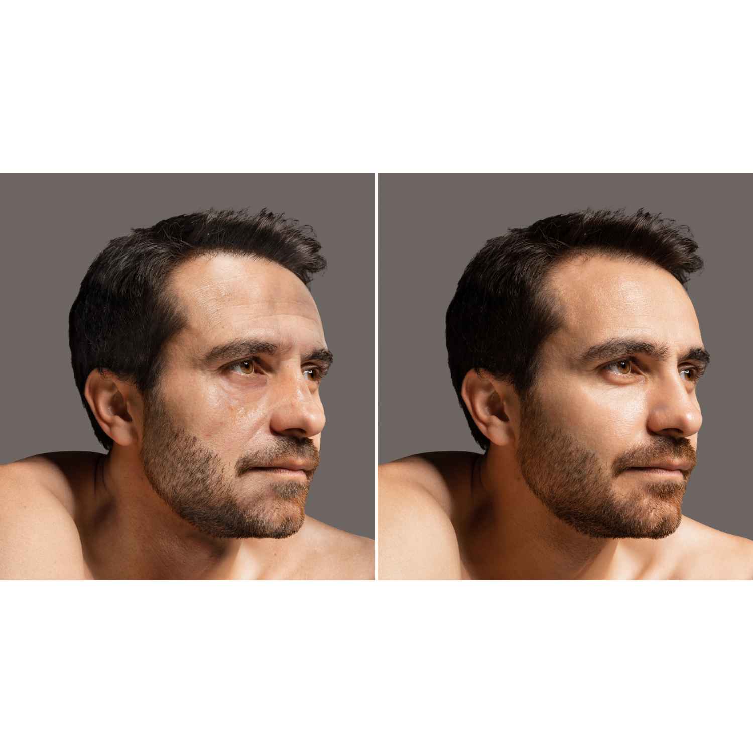Botox for men before and after Flawless Skin MedSpa Newyork