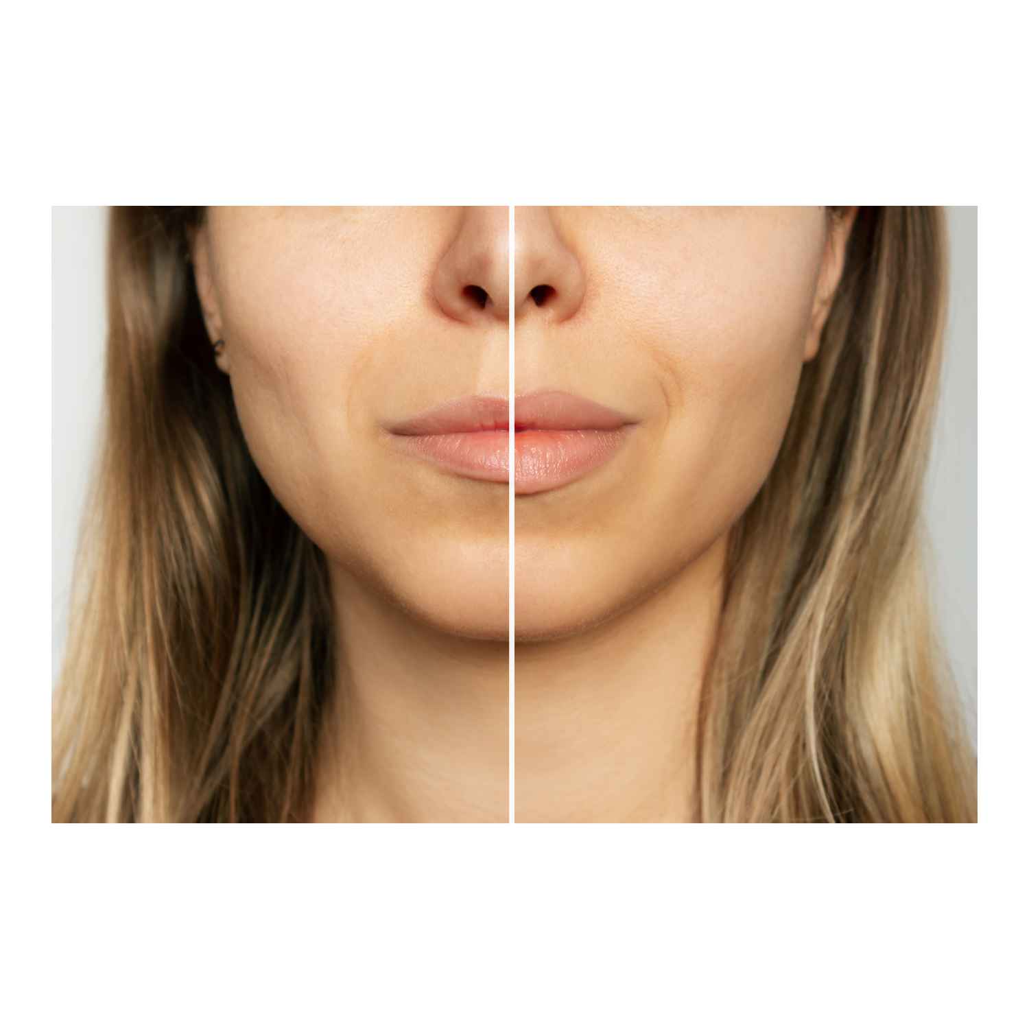 Dermal Fillers before and after Flawless Skin MedSpa Newyork, NY