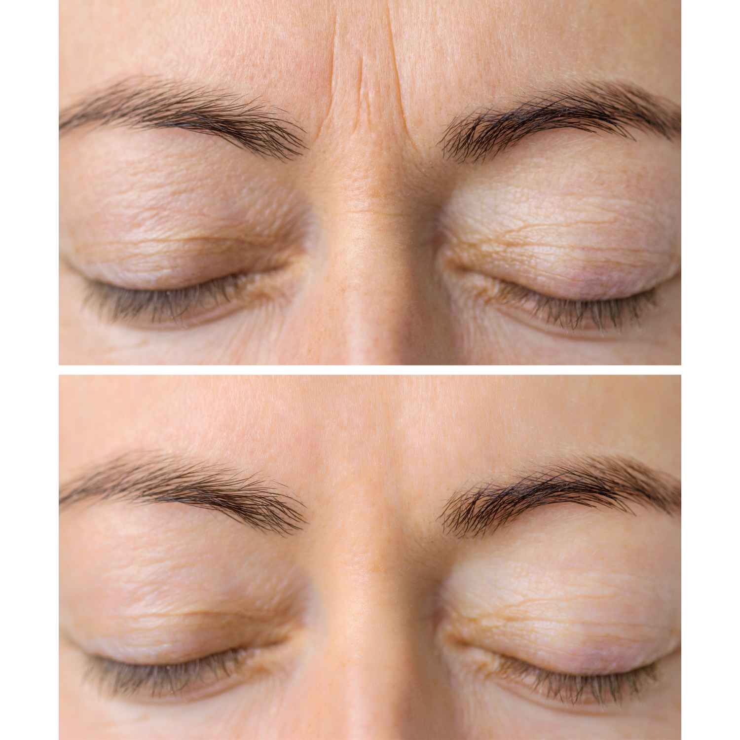Wrinkle Relaxer Before and After Flawless Skin MedSpa Newyork