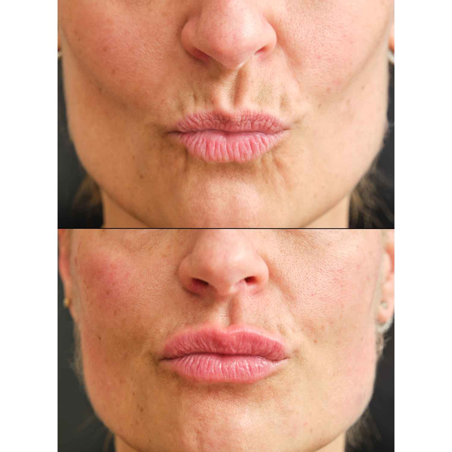 Wrinkle Relaxer Service Before and After Flawless Skin MedSpa Newyork