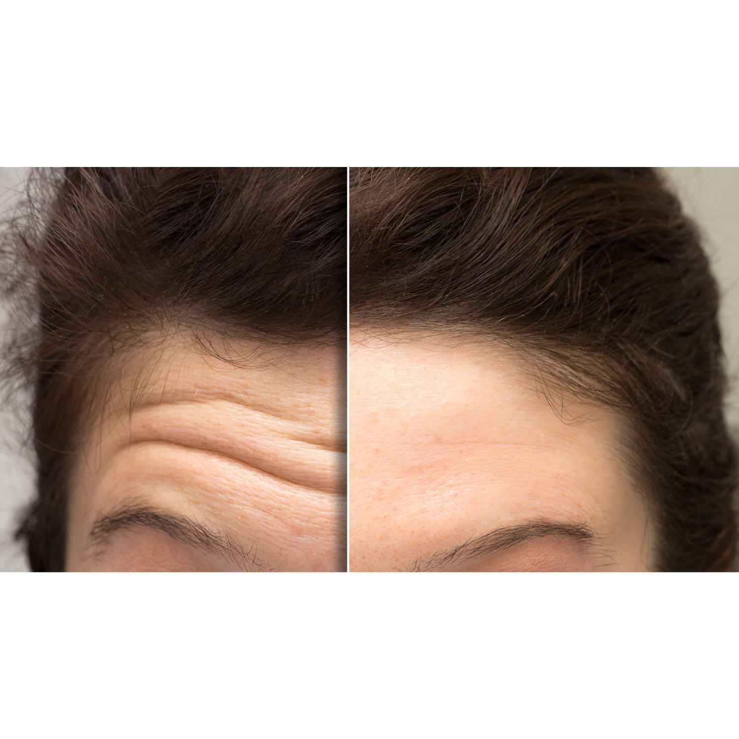 Wrinkle Relaxer Services Before and After Flawless Skin MedSpa Newyork