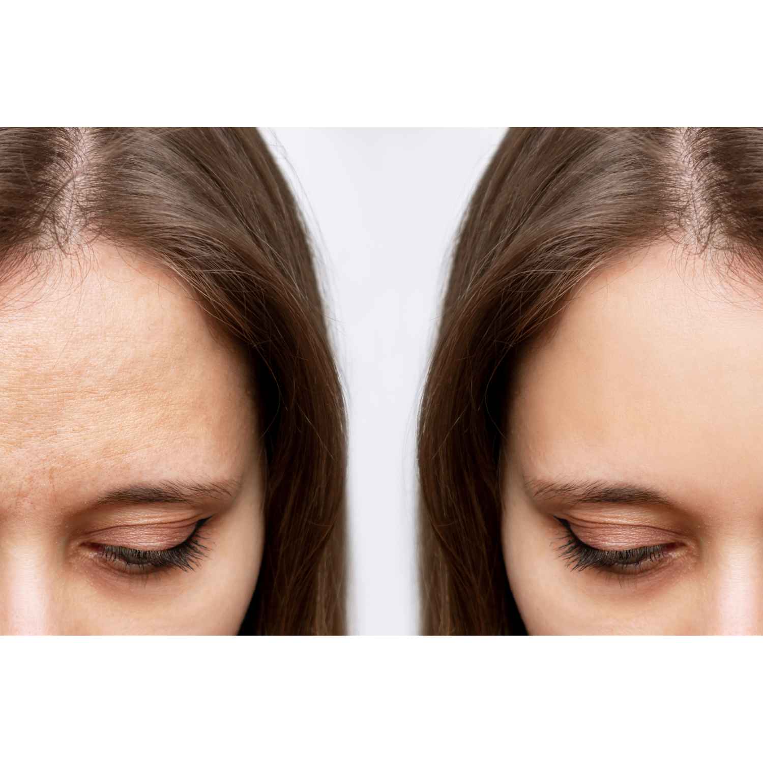 Wrinkle Relaxer Treatment Before and After Flawless Skin MedSpa Newyork